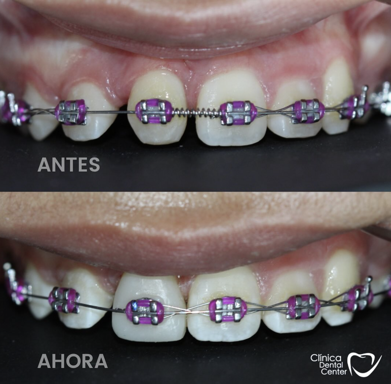 Brackets Metálicos